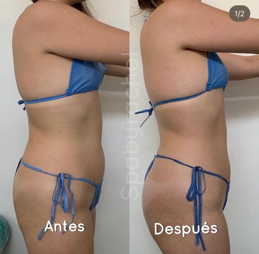 Caso corporal atendido por Rachel