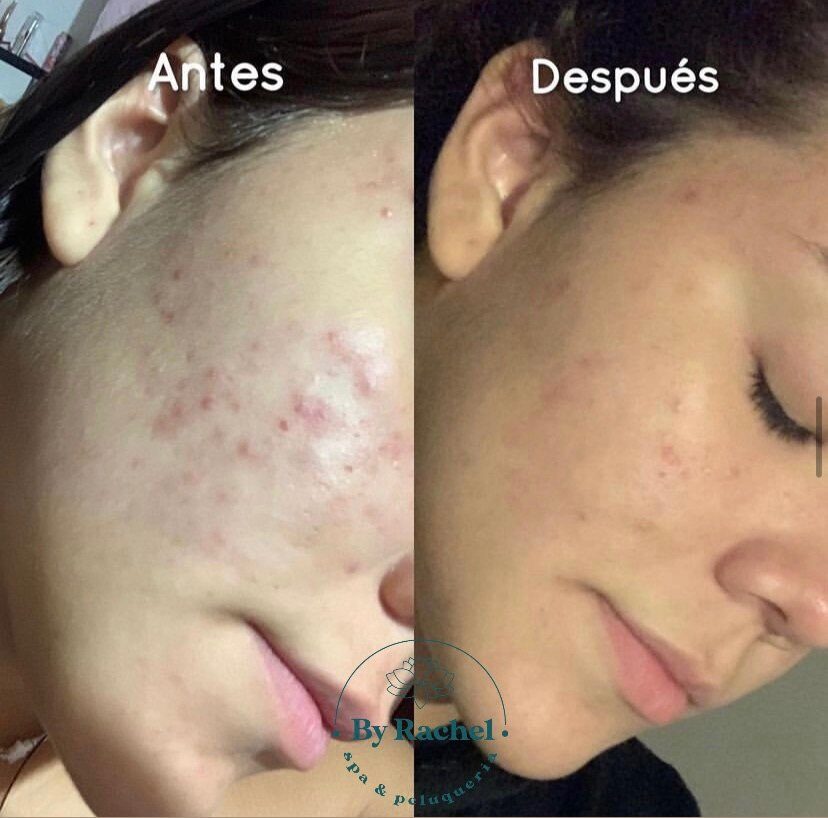 Antes y después de cuidado facial